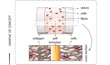 human disease model for atherosclerosis