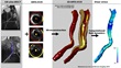 Atherosclerosos Biomechanics